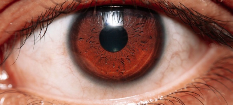 hypnose